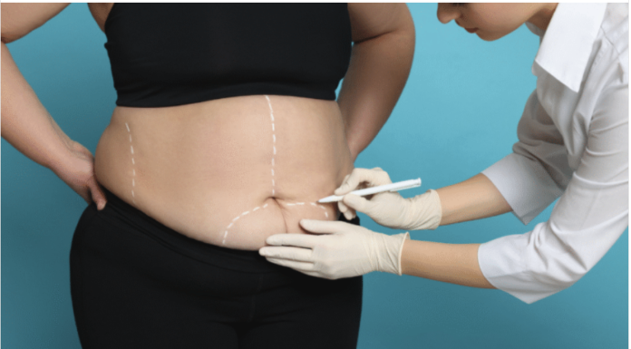 How to Choose a Bariatric Surgeon for Your Weight Loss Needs Bariatric Surgeon